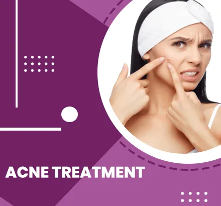 best Acne Treatment for Women in Bardoli 