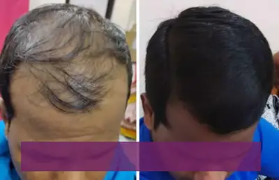Hair Regrowth Treatment, best Hair Regrowth Treatment in Gujarat