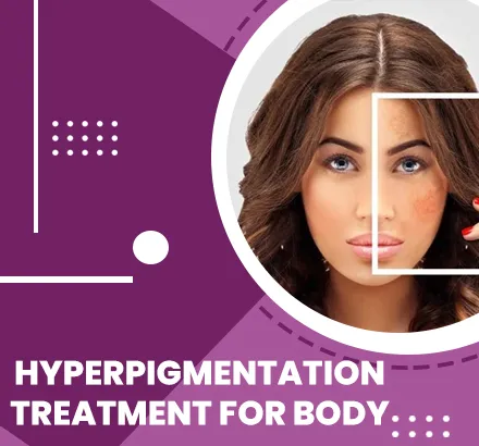 best Hyperpigmentation Treatment for Body in Surat, Gujarat