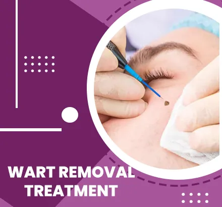 best Wart Removal Treatment and Wart Removal Surgery